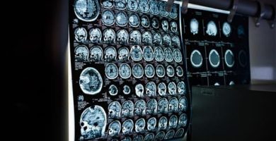 Oposiciones de enfermería tema neurología